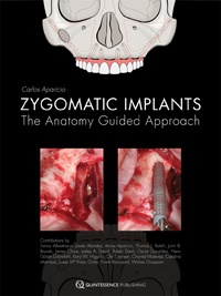 Zygomatic Implants - The anatomy guided approach