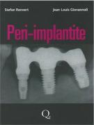 Peri - implantite
