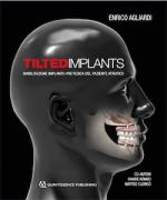Tilted Implants - Riabilitazione implanto-protesica del paziente atrofico